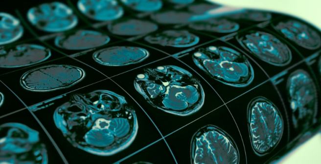 Researchers discover Toxoplasma gondii’s mechanism of infecting brain cells