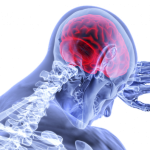 “Normal” MRI scan accompanied by dizziness—warning sign of posterior stroke