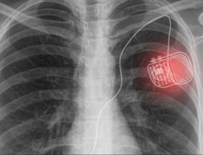  A novel active photonic wireless system to power medical implants